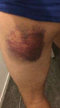 Tigh with big bruises for damage occured while riding